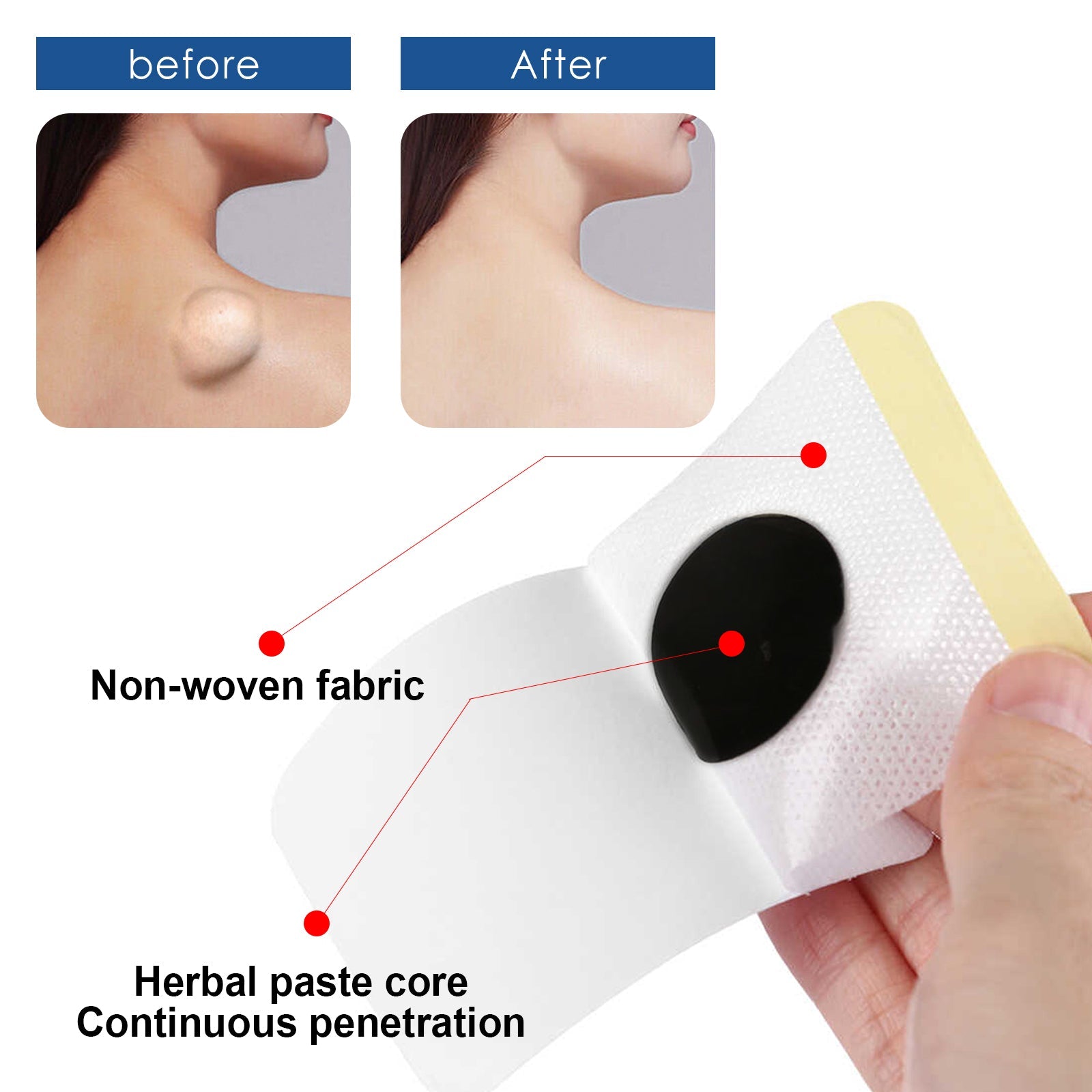 Lipoma Removal Patch, Soothing Various Body Fat Knots To Remove Subcutaneous Lumps Care Patch