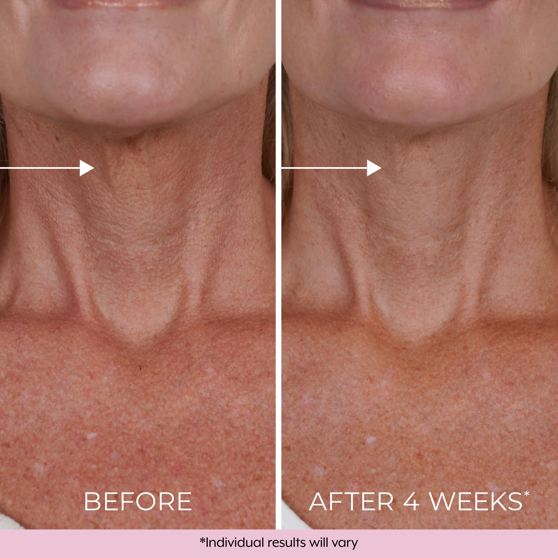 DEKLIDERM Neck Firming Cream – Anti Aging Retinol Cream Visibly Reduces Neck Wrinkles and Sagging – Neck Cream for loss of Firmness