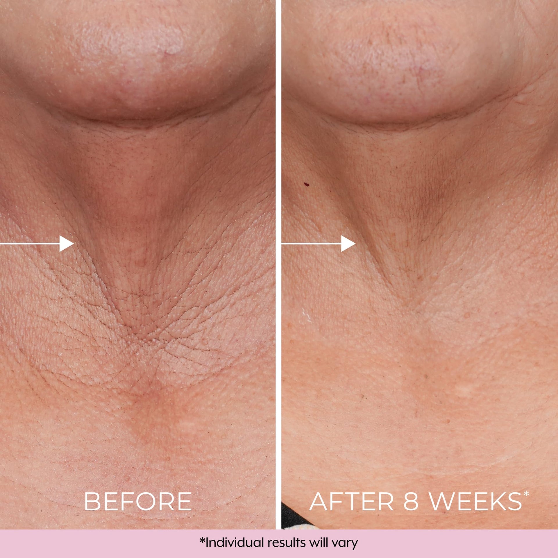 DEKLIDERM Neck Firming Cream – Anti Aging Retinol Cream Visibly Reduces Neck Wrinkles and Sagging – Neck Cream for loss of Firmness